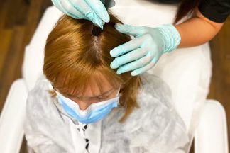 Microneedling Alopecie