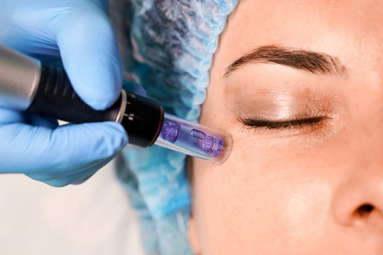 Microneedling & Mezoterapie Facială - pachet cu plata în rate lunare, Lagoon București
