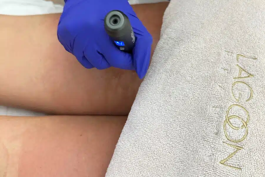Tratament FAT & CELLULITE - Administrare cocktail lipolitic prin Microneedling