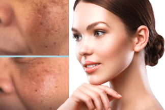 Melasma, pete pigmentare, lipsa luminozitate? Luminescens tratament + crema pentru acasa