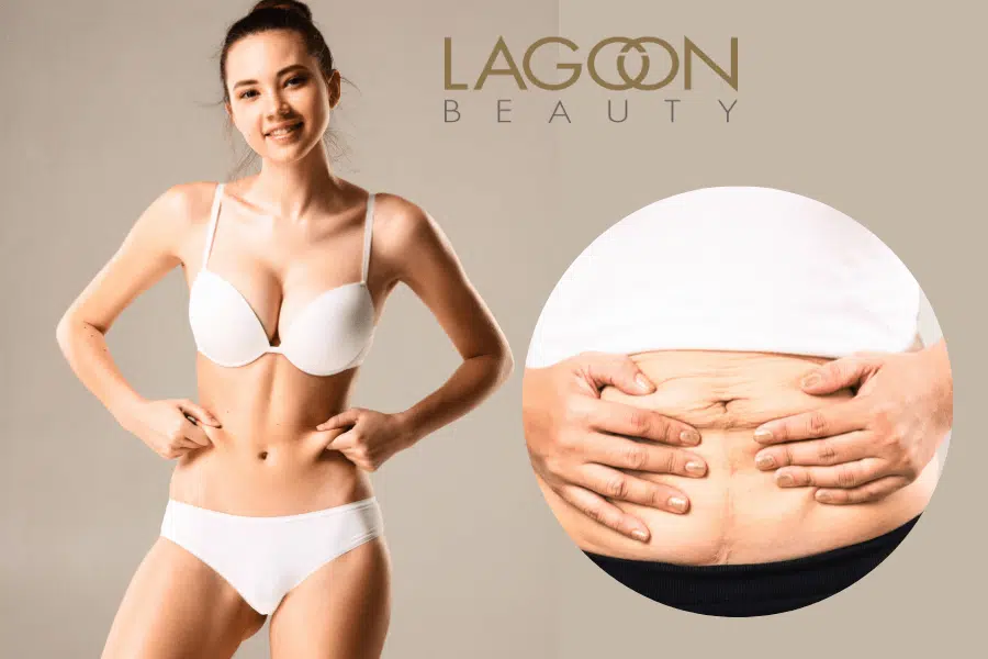 TRATAMENT  BODY FIRMING Administrare cocktail fermitate  prin Microneedling