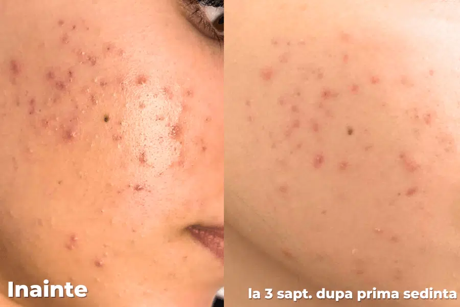 Tratament Acnee - BioRePeel + Curatare Ultrasunete