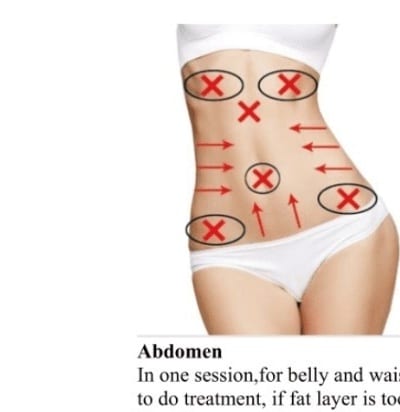 Schema zonelor de tratament HIFU corporal pe abdomen și talie
