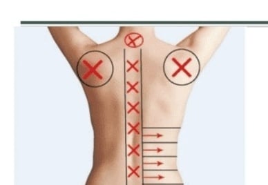 Schema zonelor de tratament HIFU corporal pe spate