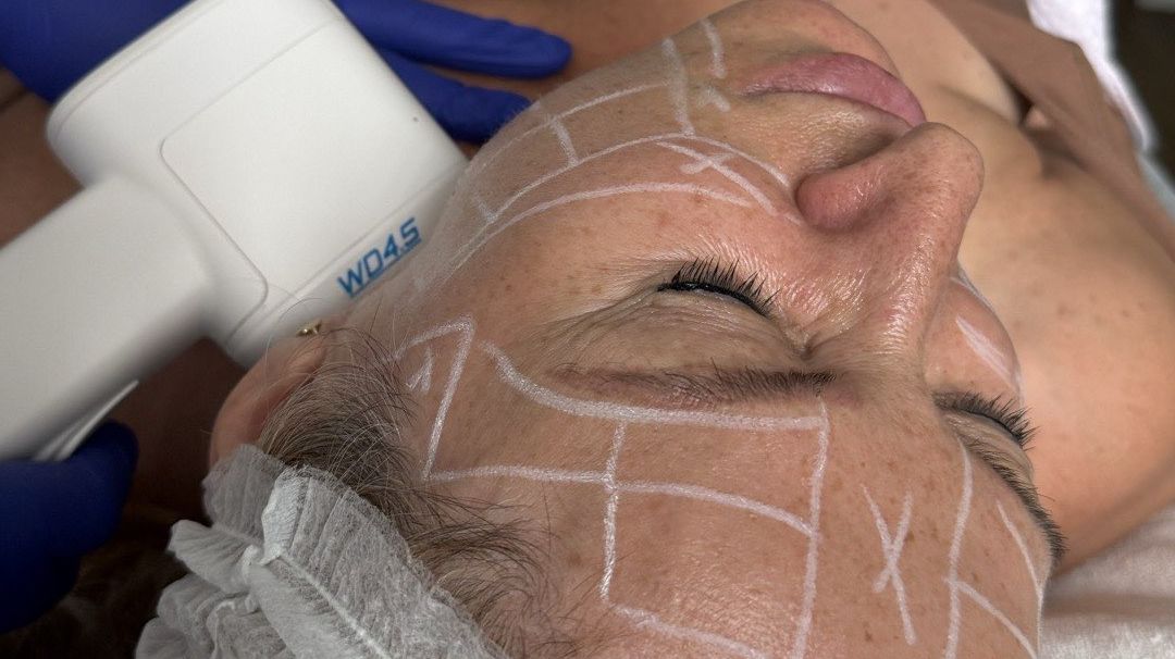 Ședință de tratament HIFU facial cu aplicatorul pe obraz la Lagoon Beauty București
