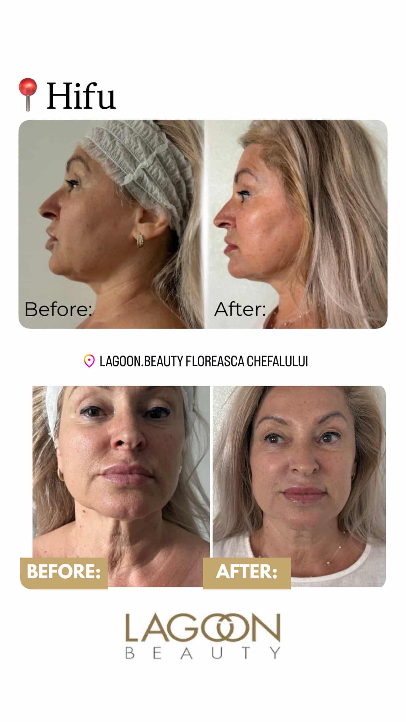 Rezultate reale HIFU facial înainte și după, clientă Lagoon Beauty